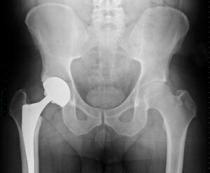 Should I use my health insurance after a car accident?